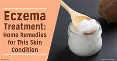 Eczema Drugs