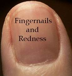 Artificial Fingernails