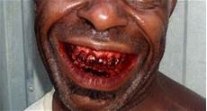 Betel Nuts