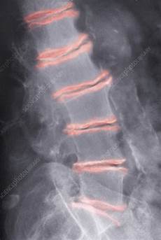 Calcium