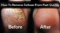 Callus Remover