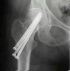 Cannulated Screws