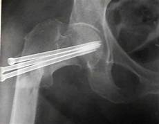 Cannulated Screws