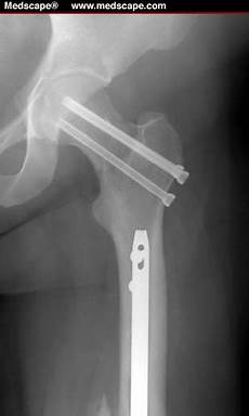 Cannulated Screws