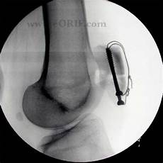 Cannulated Screws