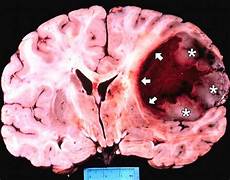 Carmustine