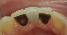 Ceramic Adhesive