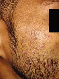 Cidofovir