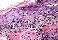Cidofovir