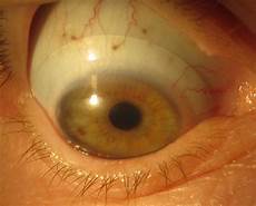 Contact Lenses