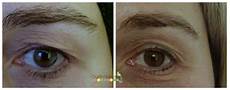 Derma Wand
