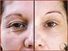 Derma Wand