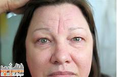 Derma Wand