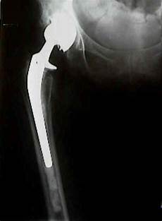 Femoral Component