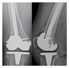 Femoral Component