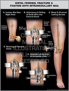 Femural Nail