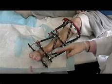 Fixator