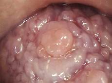 Gauze