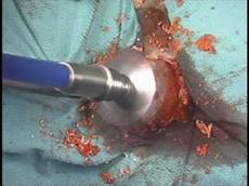 Hip Prosthesis