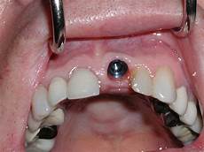 Implant