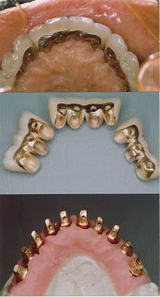 Implant