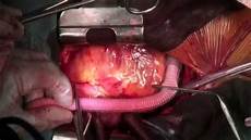 Implant