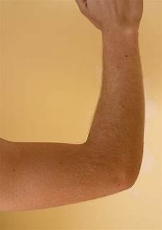 Inflated Elbow