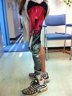 Knee Prosthesis