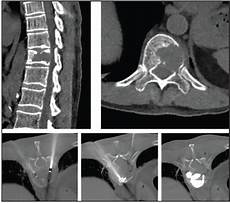 Kyphoplasty System