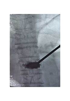 Kyphoplasty Systems