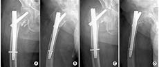 Lag Screw
