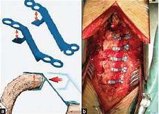 Laminoplasty Plates