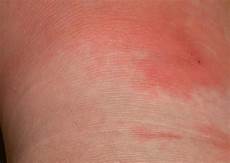 Medical Creams
