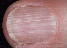 Medical Nails