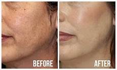 Microdermabrasion Machine