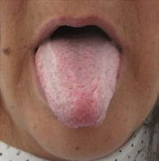Mouthwashes