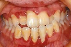 Mouthwashes