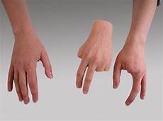 Orthopedic Prosthesis