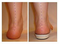 Orthoses