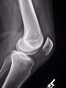 Patella