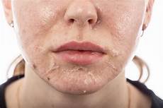 Peeling