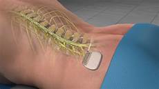Spinal implant