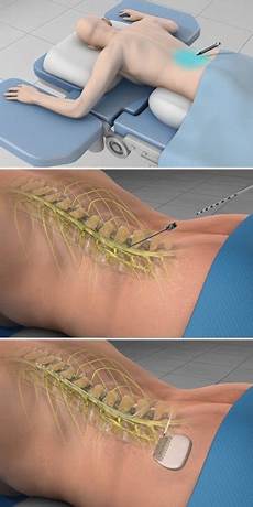 Spinal implant