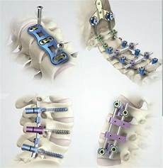 Spinal implants