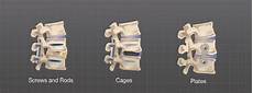 Spinal implants
