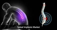 Spinal implants