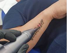 Tattoo Removal Machine