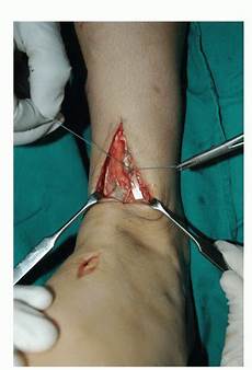 Tendon Bands