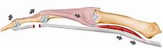 Tendon Bands