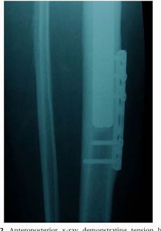 Tibial Stem